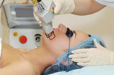 soorten laser gezichtshuidverjonging